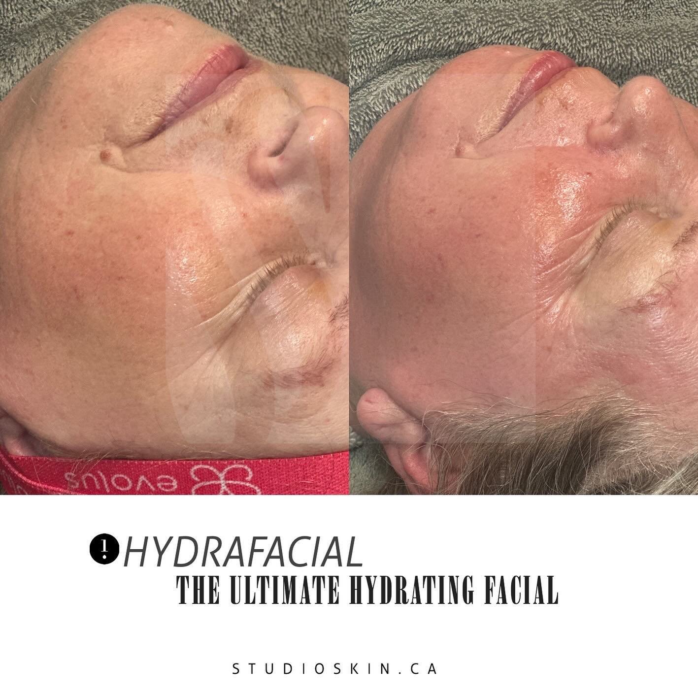 💧Our HydraFacial is a multi-step treatment that deeply cleanses, exfoliates, extracts, and hydrates the skin using a patented Vortex-Fusion delivery system. 

✨It&rsquo;s beneficial for the skin because it effectively removes impurities, hydrates de