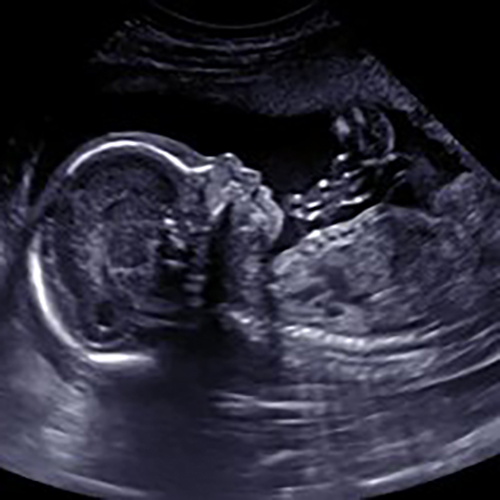 2D ultrasound 