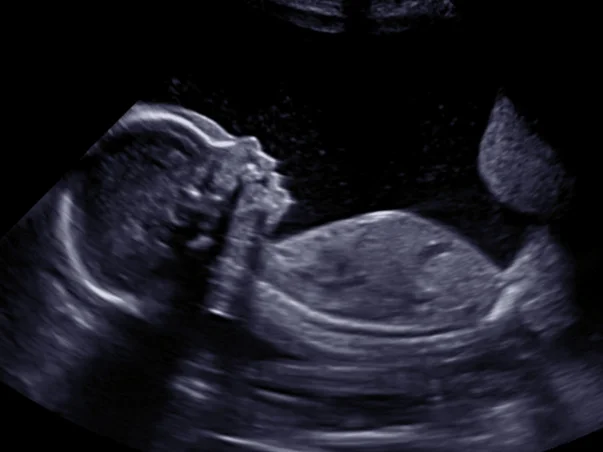 20 weeks 2D profile ultrasound sonohealth