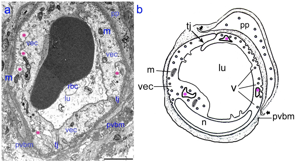 The BLB in a Meniere’s disease capillary. a) Capillary located in the stroma of the macula utricle from a Meniere’s subject (55-year-old-male). The lumen (lu) of the capillary is narrow, vascular endothelial cells (vec) are swollen and the cytoplasm is vacuolated (pink asterisks). b. Diagram showing the alterations in the swollen vec, microvacuoles are also abundant (v). Abbreviations, rbc: red blood cells, tj: tight junctions, m: mitochondria, n: cell nucleus, pp: pericyte process; pvbm: perivascular basement membrane. Bar is 2 microns.