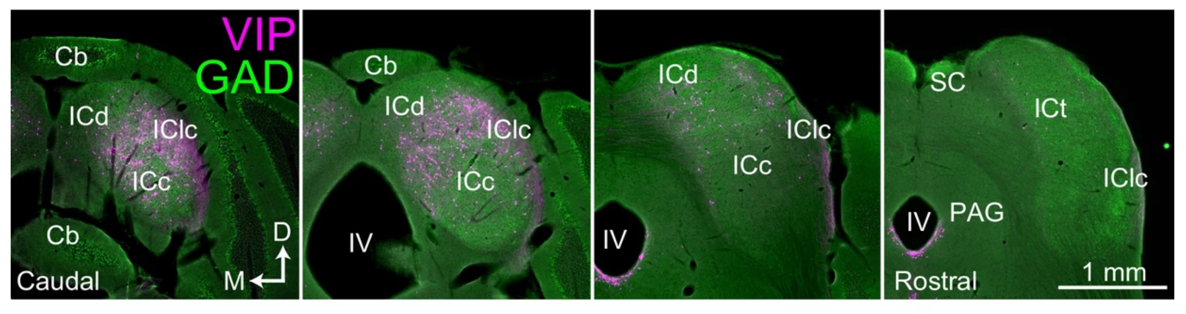 Sections of the inferior colliculus, the hub of the brain’s auditory pathway. A newly identified neuron type called VIP neurons, which make a small protein called vasoactive intestinal peptide, have been dyed magenta.