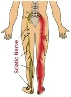 Sciatica 1