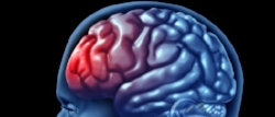 mild-traumatic-brain-injury.jpg