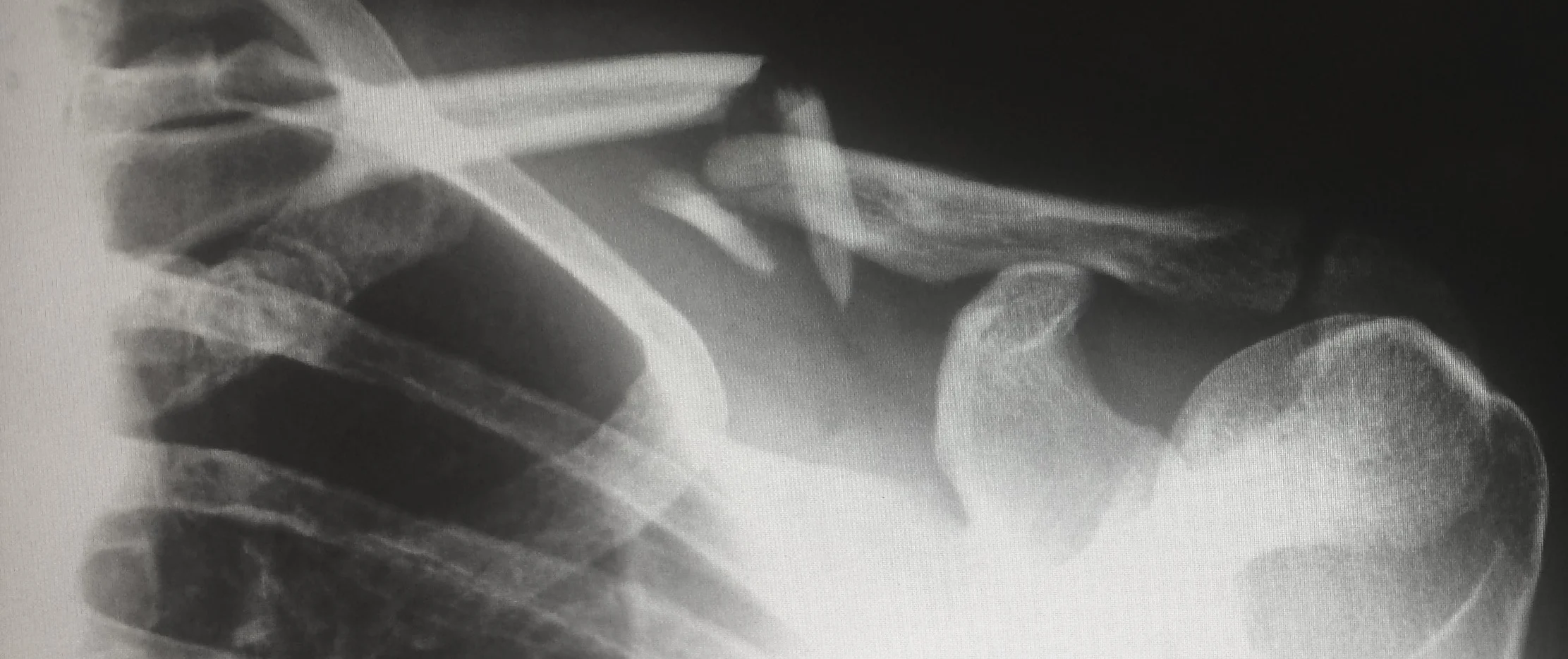 Photograph: x-ray of badly-fractured shoulder, with bone displacement.