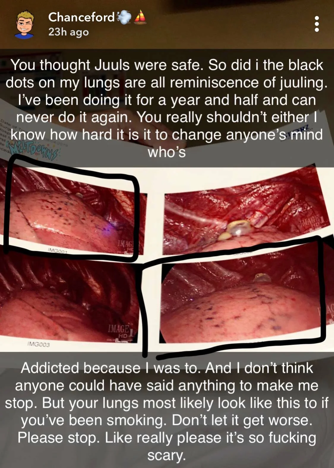Twitter posting of Chance Ammirata from the August 8, 2019, New York Post article located at https://nypost.com/2019/08/08/student-shares-shocking-images-of-collapsed-lungs-after-vaping-for-a-year/