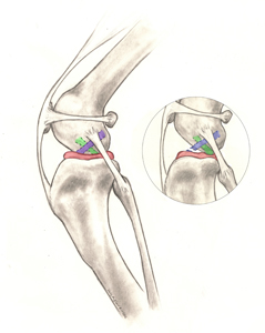 Figure 1. Illustration of the anatomy of the dog’s knee: Blue = cranial cruciate ligament; Red = meniscus; Green = caudal cruciate; the insert shows a ruptured cranial cruciate ligament (also note that the shinbone is displaced forward and is crushing the meniscus) Image from www.acvs.org