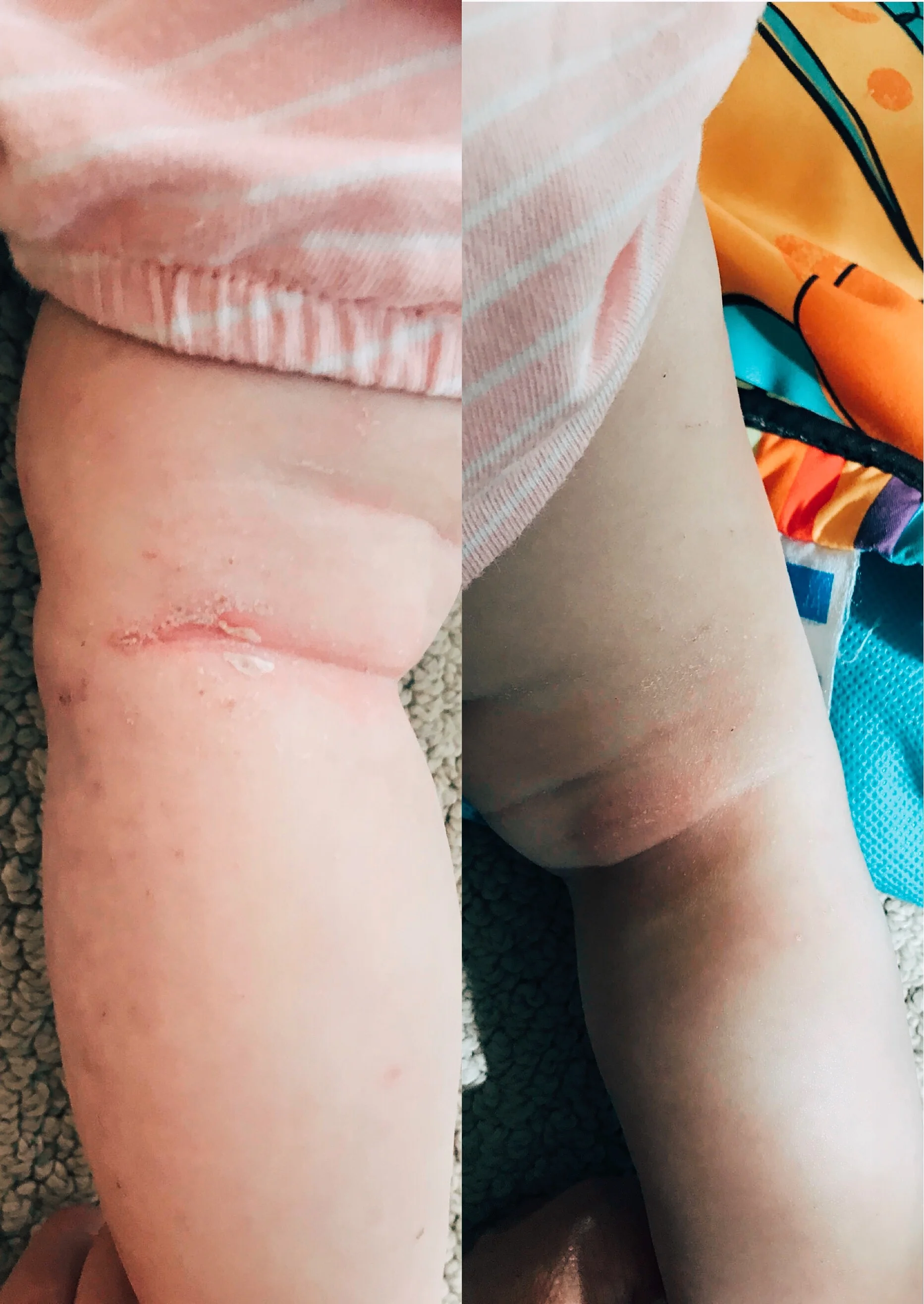 Healing, but not fast/good enough for me!