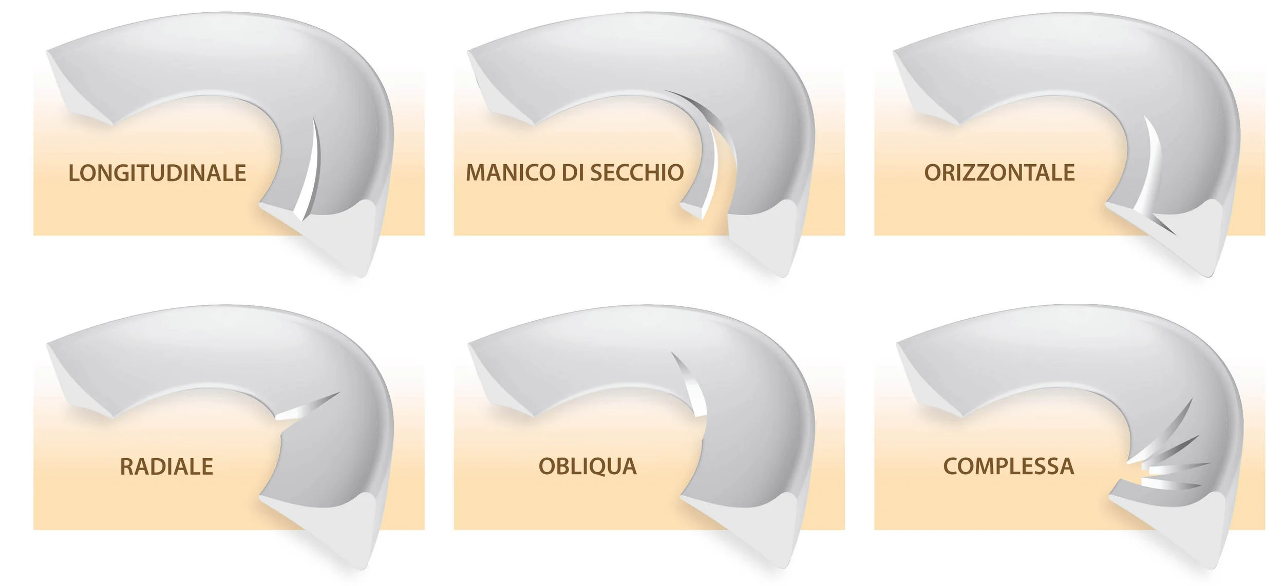 Tipi di lesioni meniscali