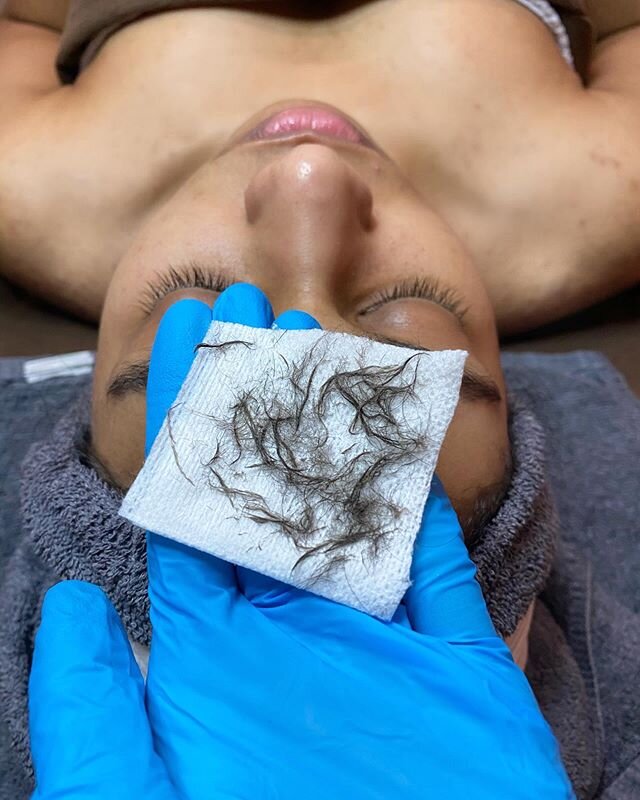 Another one Bites the Dust😈😱 (Enhanced Dermaplaning)