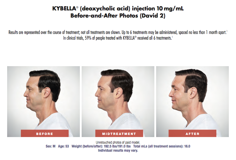 Kybella_David.png