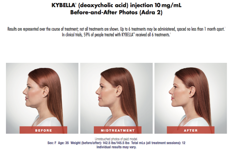 Kybella_Adra.png