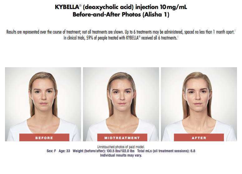 Kybella_Alisha.png