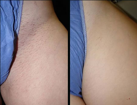 Bikini Area Before & After