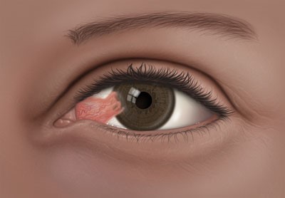 Pinguecula or "Surfer's Eye"