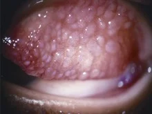  GPC on everted upper eyelid