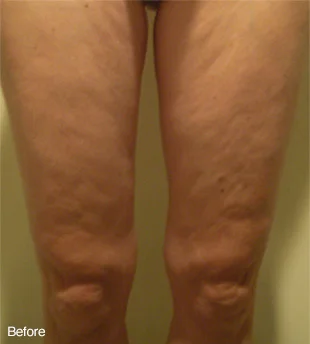 Before Light Therapy