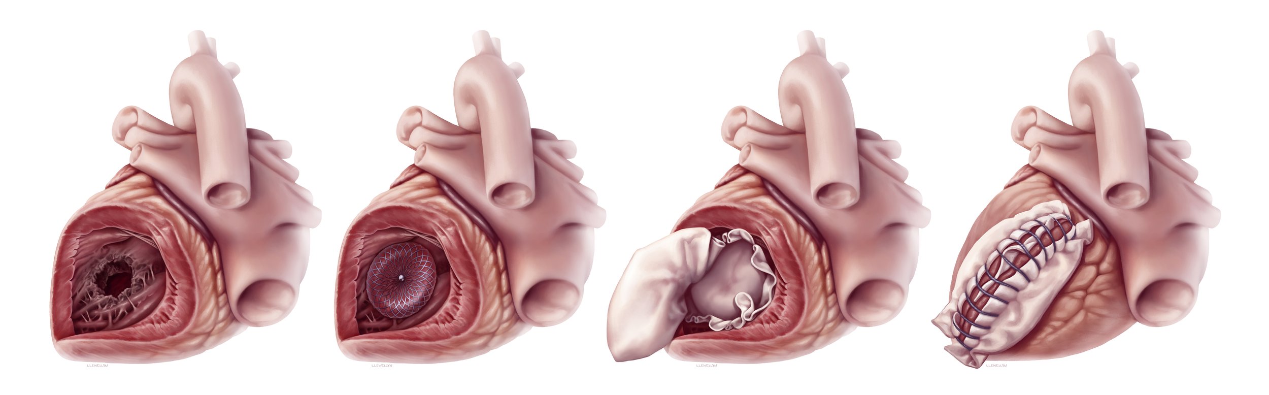 Post-myocardial infarction ventricular septal defect repair