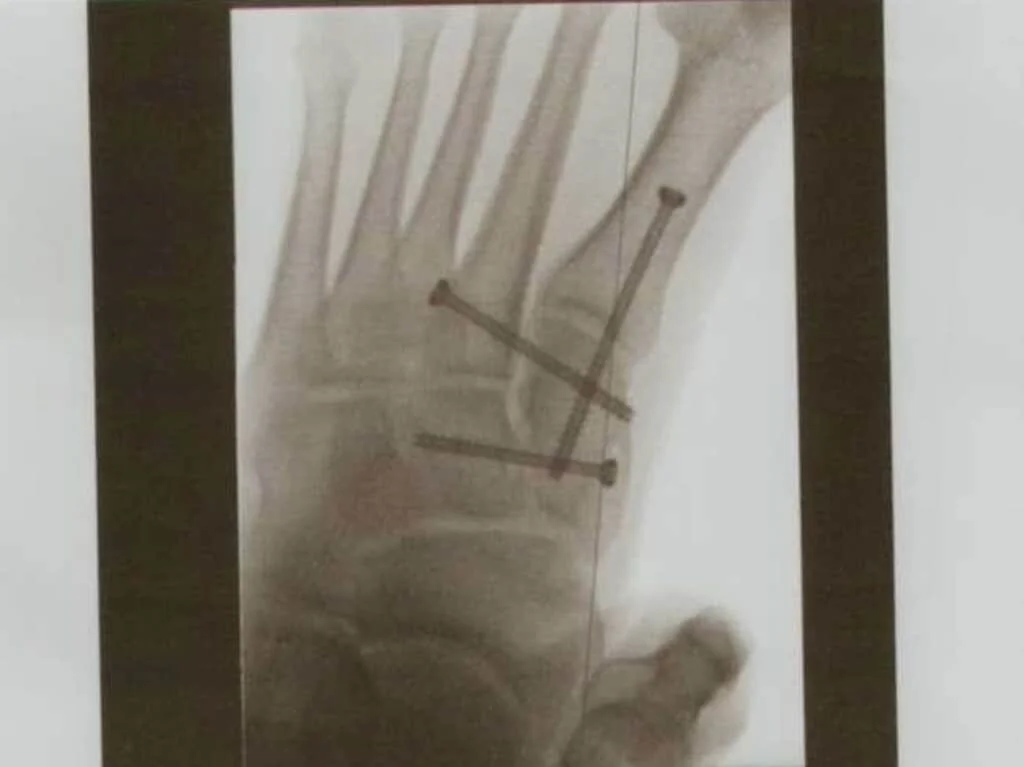X Ray foot .jpg