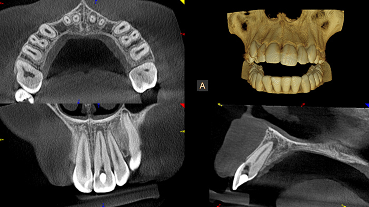 Cone Beam CT 3D Scan Endodontics - NYC Endodontists & Manhattan Root Canal Specialist Dentists
