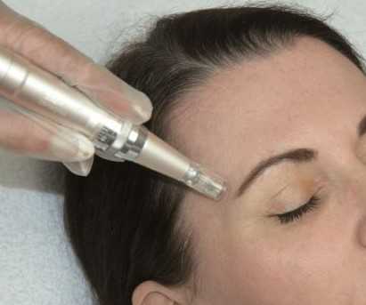 needling.jpg