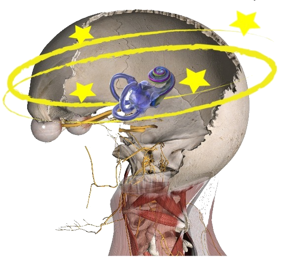 Cervicogenic Dizziness, Cervical Vertigo, Concussion, Dix-Hallpike Manuever