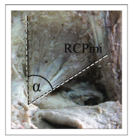 RCPmi dissection. Photo courtesy of Yuan et al 2017