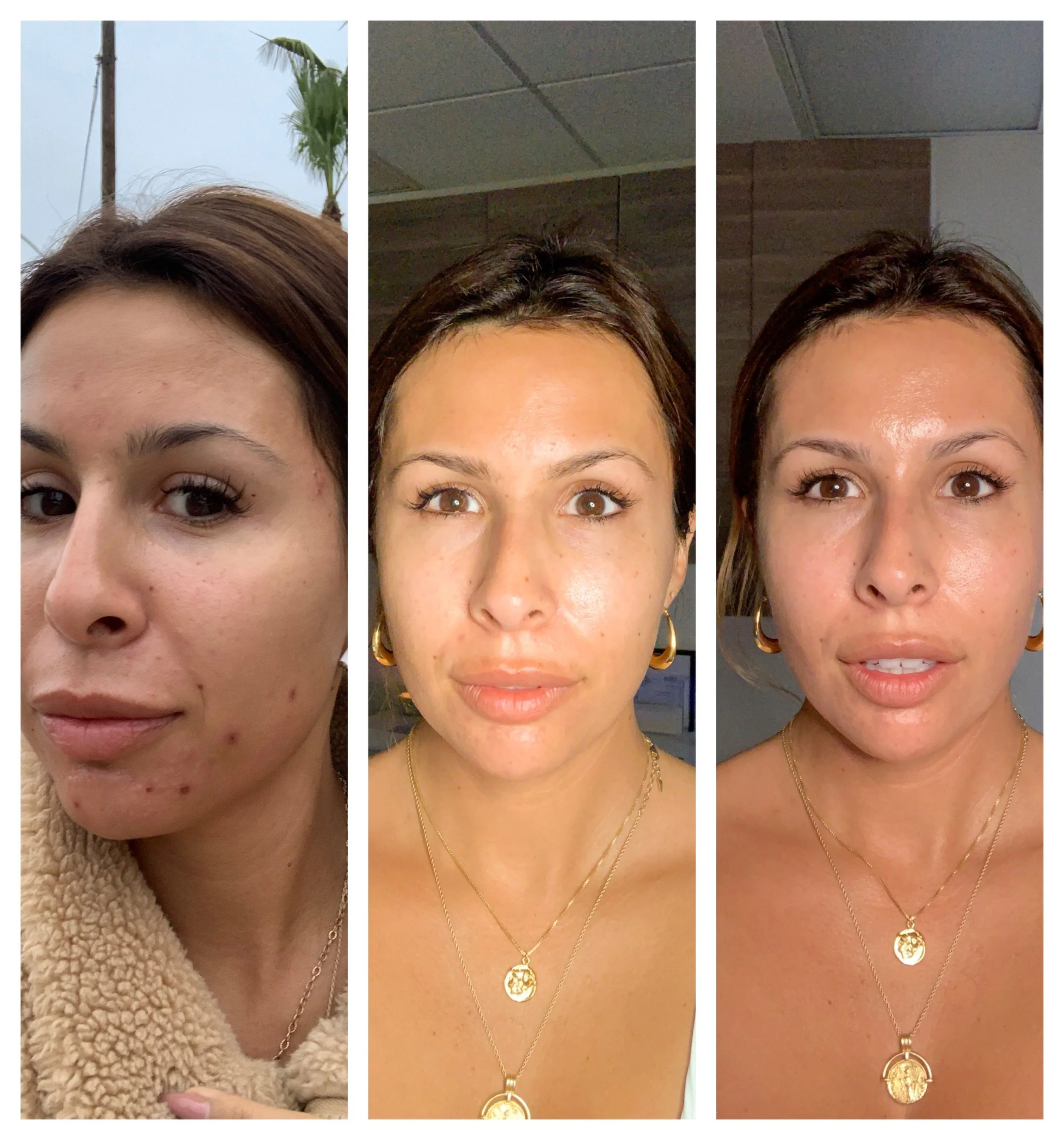 going on birth control for acne