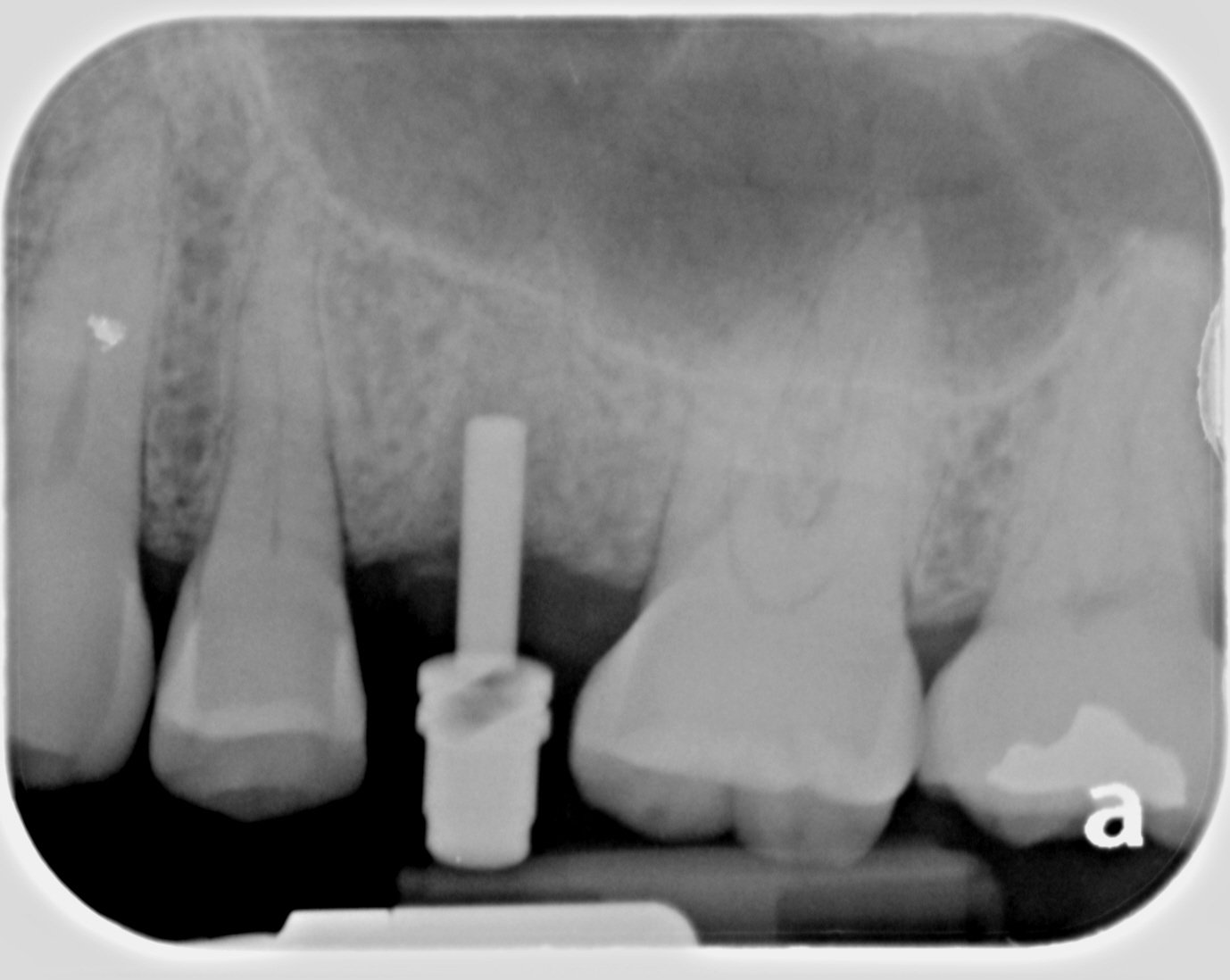 18 Implant placement1.jpg