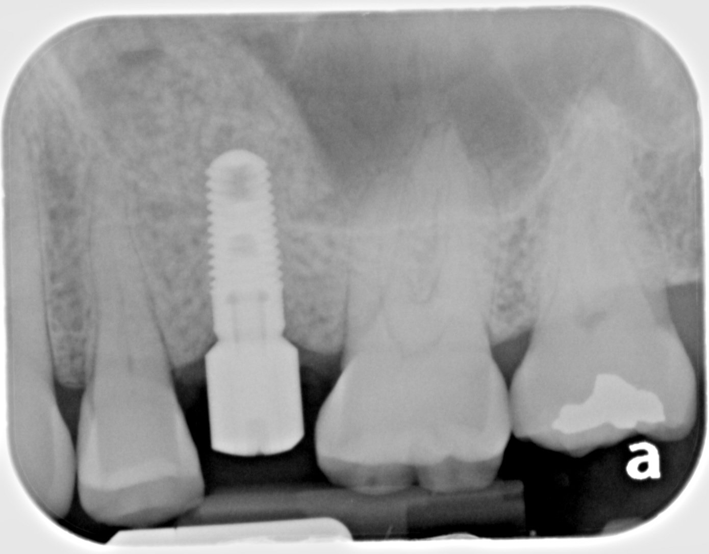 18 Implant placement2.jpg
