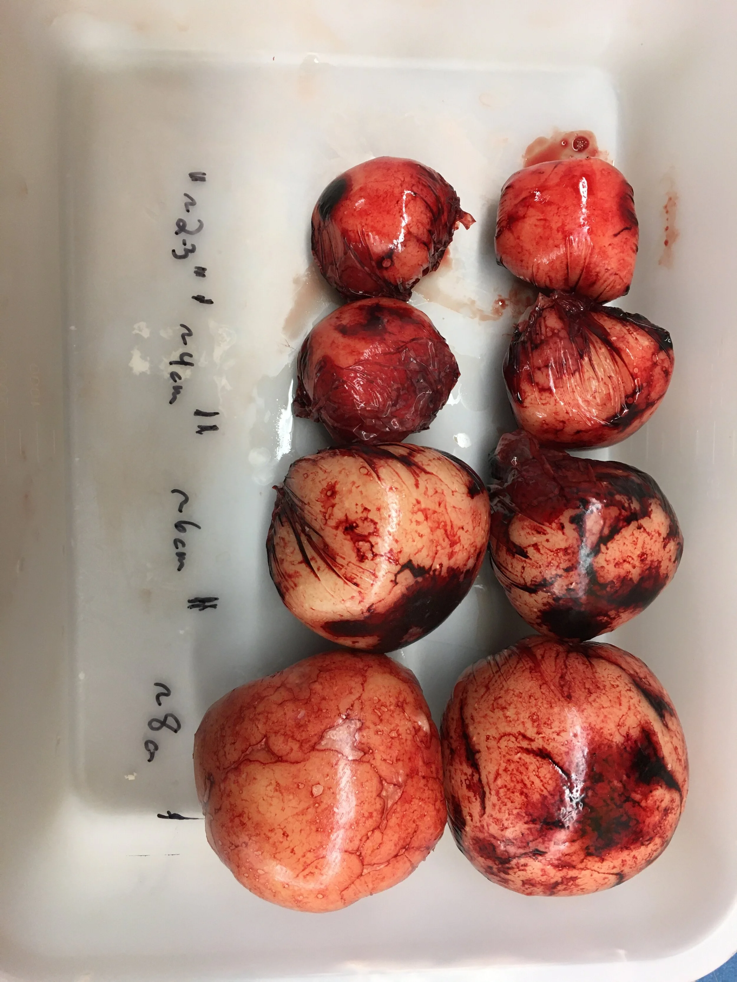 uterine-fibroid-embolization-ufe-mark-fibroid-care
