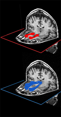 Brain scans showing the white-matter pathways involved in everyday learning: Top, the pathway shown in red that connects the medial prefrontal cortex to the ventral striatum and, bottom, the pathway shown in blue that connects the medial prefrontal cortex to the thalamus. 