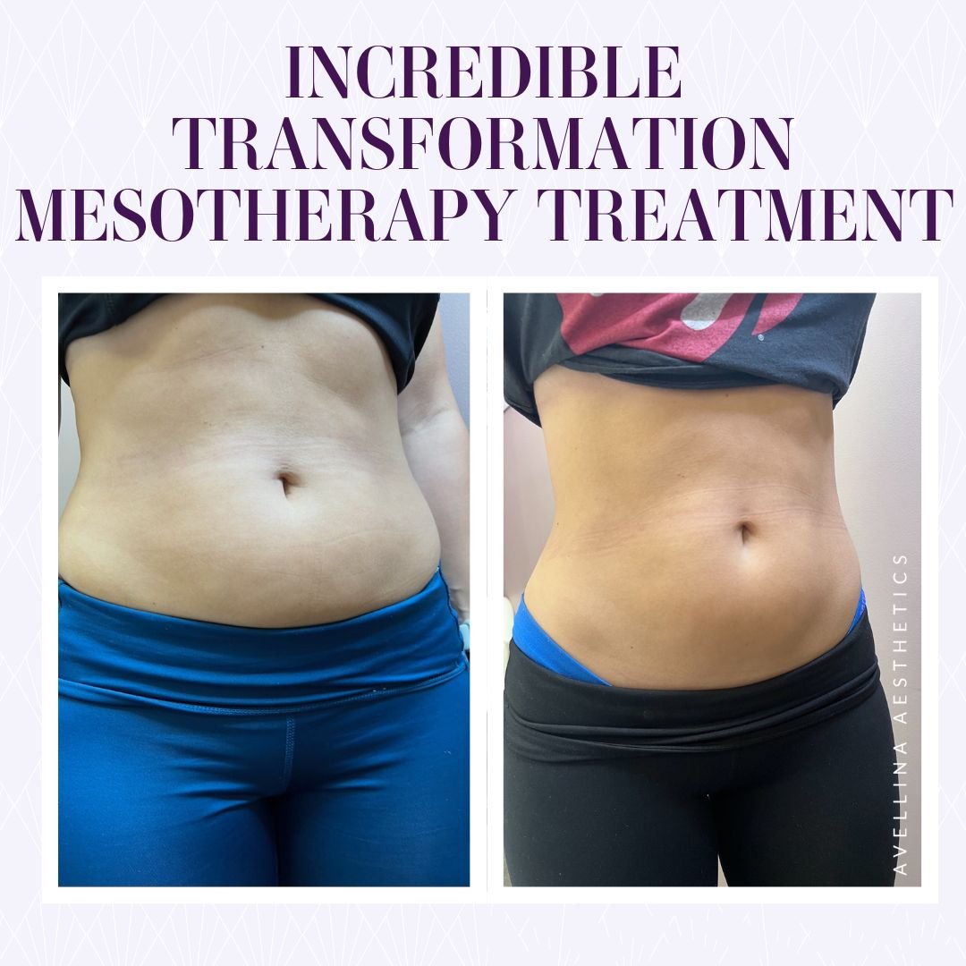 Mesotherapy For Weight Loss Melt Stubborn Fat Sculpt The Body You 