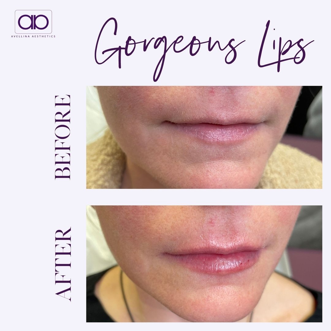 💋 Unveil the Fuller, More Luscious Lips You Deserve! Imagine a boost of confidence with every smile, every pout, every mirror glance. 

That's the beauty of lip fillers - not just enhancing your look, but elevating your self-esteem. 

✨ Whether you&