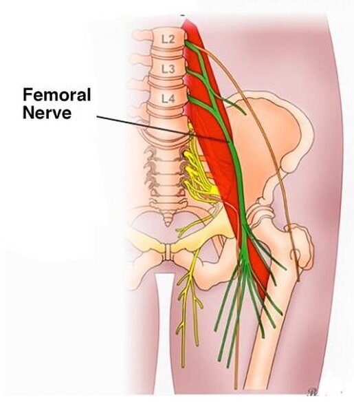 The femoral nerve exits the lumbar spine from L2- L4.

.

Compression can occur anywhere along the route starting at the spine, through the iliopsoas, under the inguinal ligament and into the soft tissues of the quads.

.

This large nerve controls m