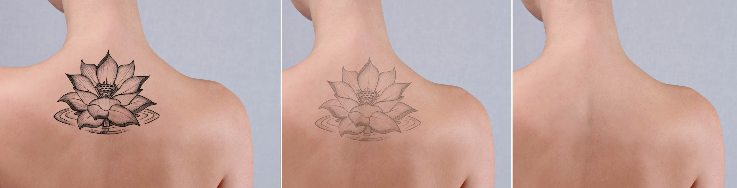 Choose The Best Laser Tattoo Removal Dr in Bristol