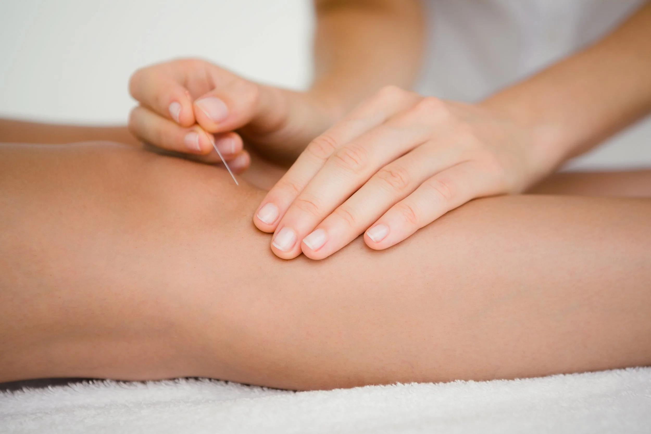 Acupuncture.jpeg
