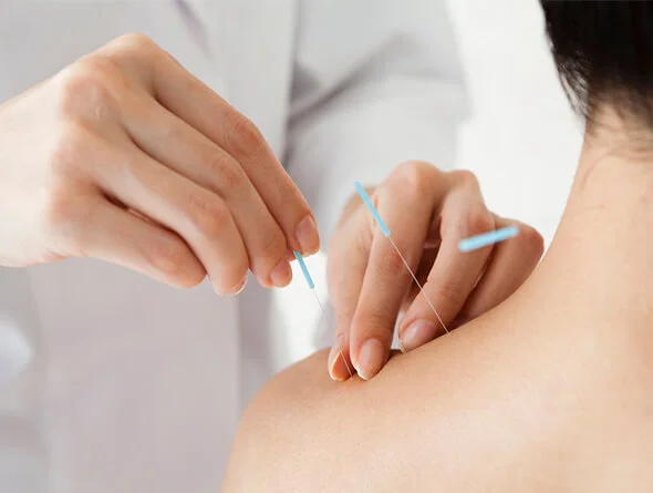 ACUPUNCTURE SHOULDER.jpg