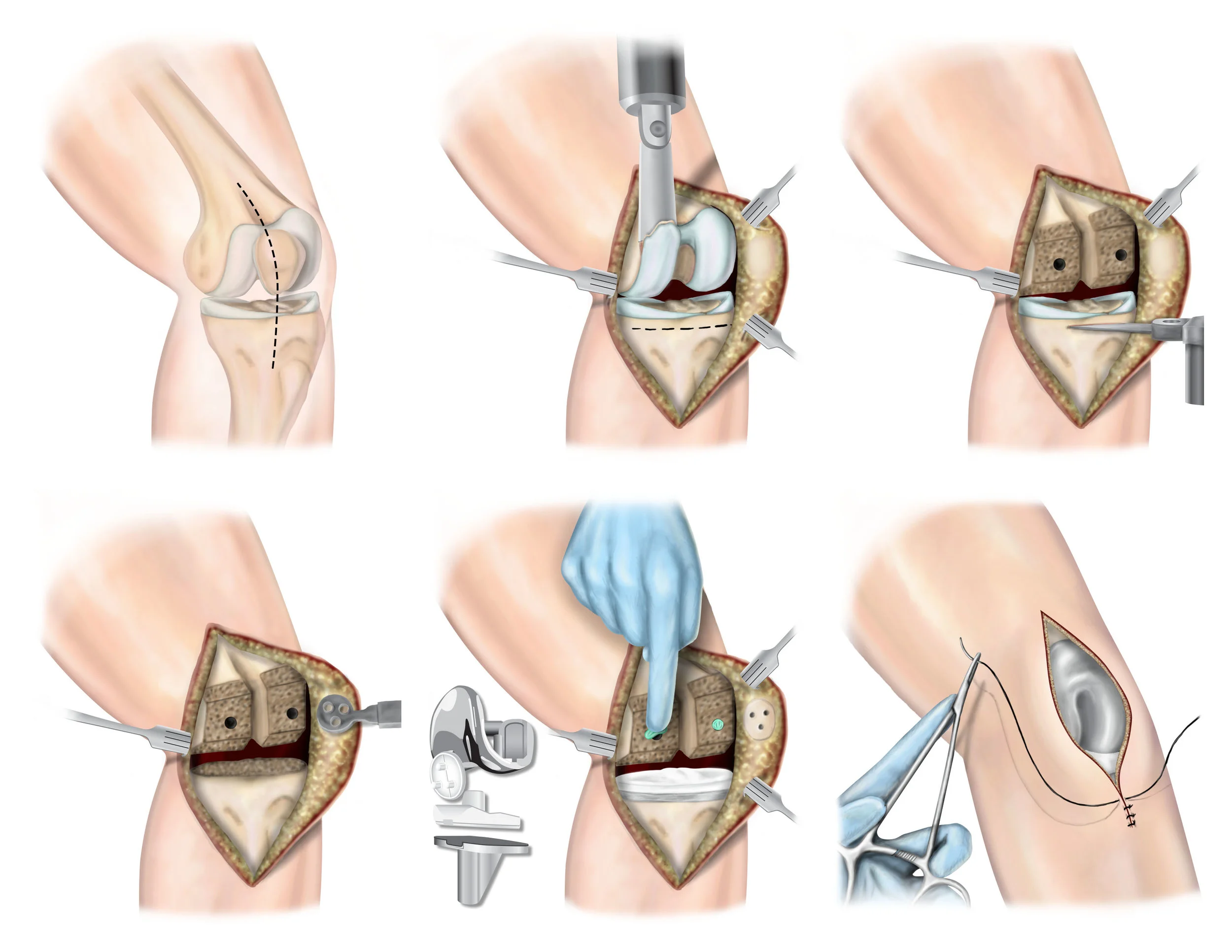 Total Knee Replacement