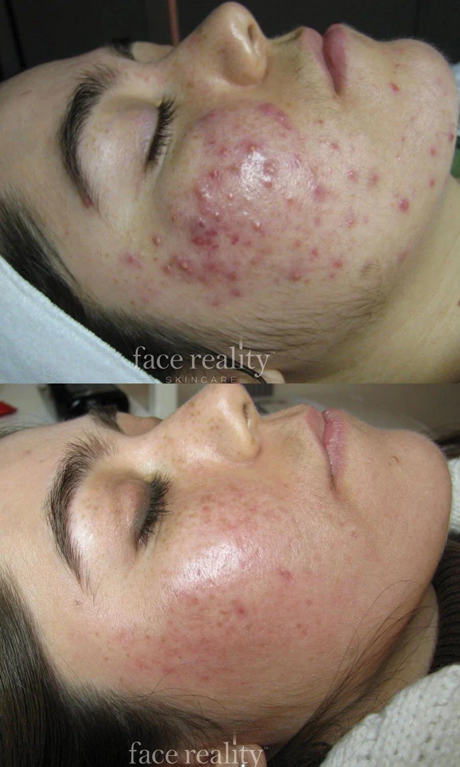 Face Reality Skincare before And After WIXARO