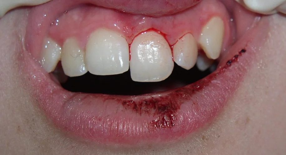 Loose tooth following trauma