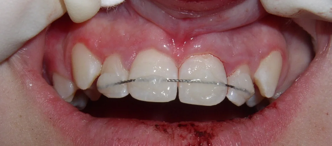 Tooth put back in original place and splinted