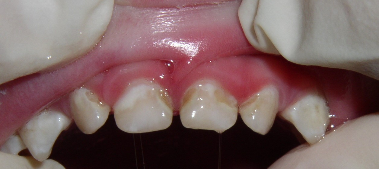 Faq Are The Stains On My Childs Teeth Cavities — Discovery