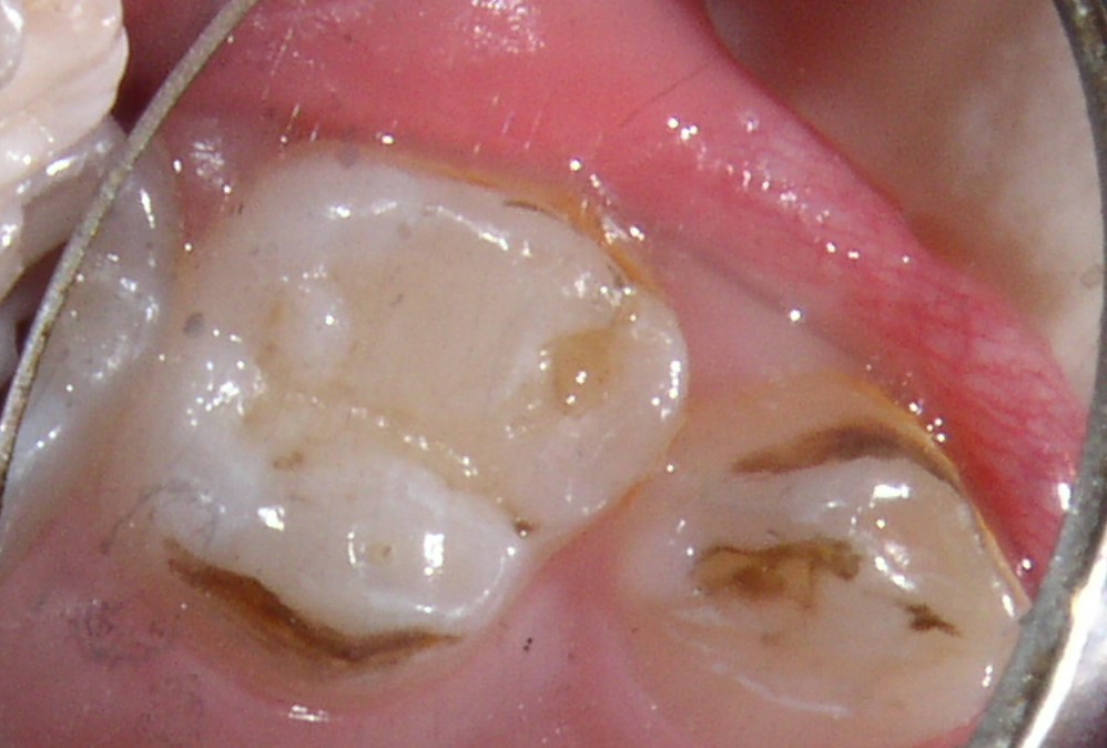 brown spots on teeth near gums