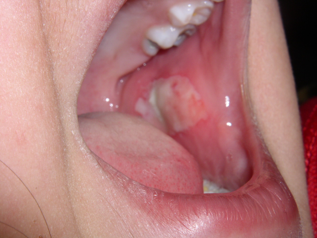 FAQ - Bitten Lip — Discovery Pediatric Dentistry