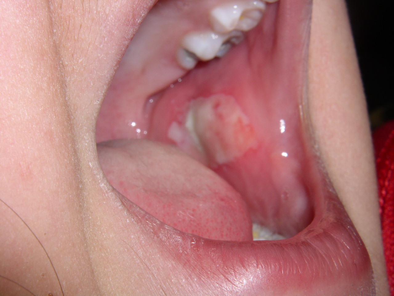 INside of cheek bitten after dental treatment