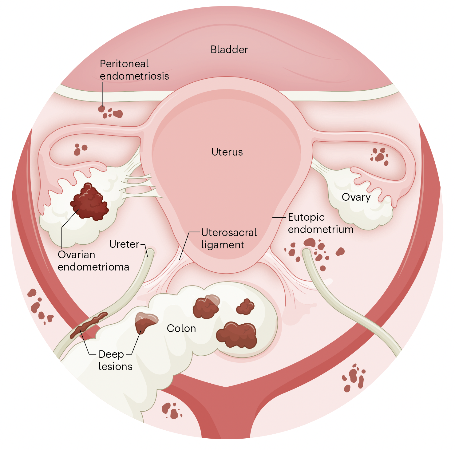 J Vallis Endometriosis.png