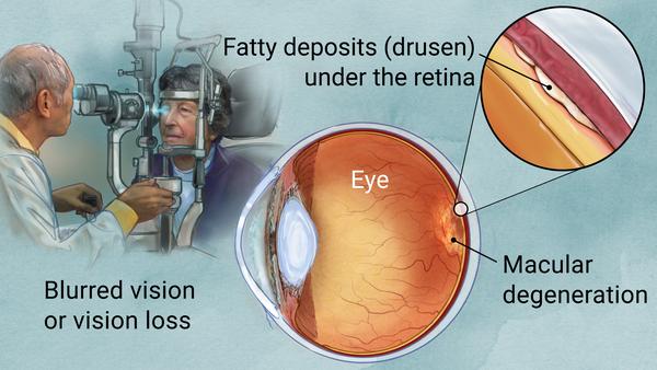 An eye disease that causes permanent vision loss.