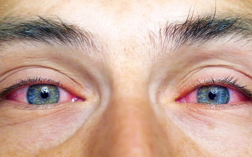 We treat many eye conditions - red eyes, infections, injuries, and more