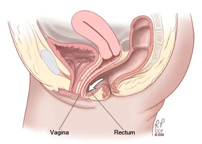 Rectocele (posterior vaginal wall prolapse)