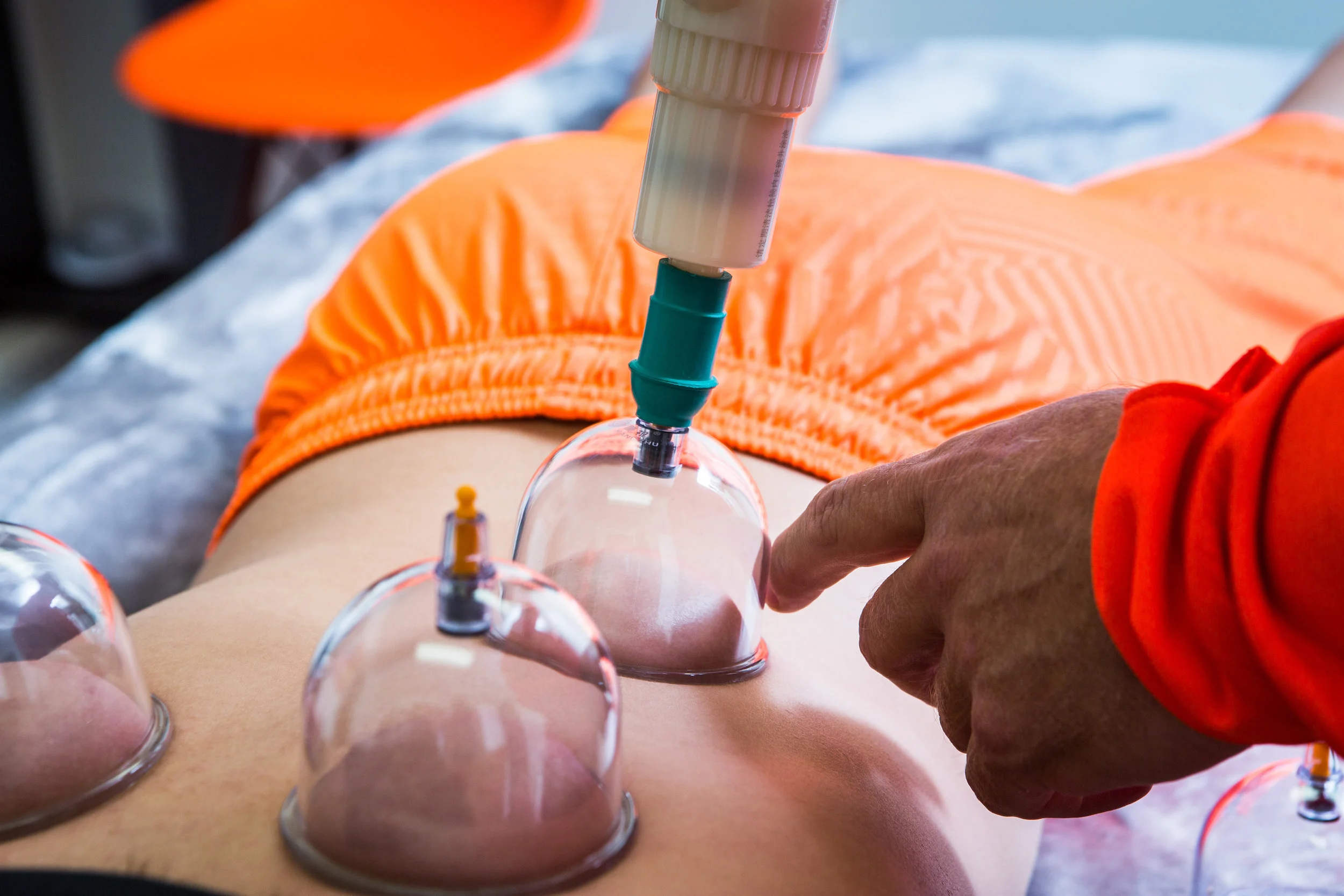 Athlete having cupping therapy at Athletic Edge in Scotch Plains, NJ